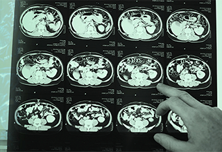 hippocampal-atrophy-mri-1.0